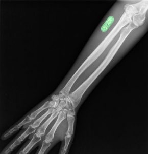 Figure 1‑21: Project Bionic Yourself (B10N1C) implant in arm